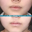 【10代女性】M字リップ（キュートリップ、切開法） 30日後 サムネイル用
