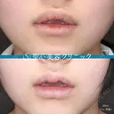 【10代女性】M字リップ（キュートリップ、切開法） 30日後 サムネイル用