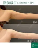 カリカリボディを目指す🌴コンプリート脂肪吸引【上腕全周～お背中一部】形成外科専門医がご対応 before画像 サムネイル用