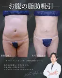 ぽっこりお腹卒業🎓⭐ before画像 サムネイル用