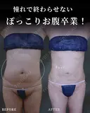 ぽっこりお腹卒業🎓⭐ after画像 サムネイル用