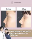 鼻尖形成　軟骨移植 after画像 サムネイル用