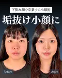 岩﨑先生による✨小顔整形✨ before画像 サムネイル用