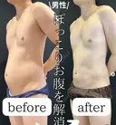 男性のぽっこりお腹も脂肪吸引でスッキリ変わる❗️ 90日後 サムネイル用
