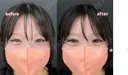 涙袋ヒアルロン酸 after画像 サムネイル用