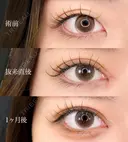 目頭切開 before画像 サムネイル用