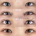 目頭切開 30日後 サムネイル用