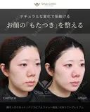 顔すっきりセット・ナゾラビアルファット・VOVリフトプレミアム before画像 サムネイル用
