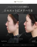 顔すっきりセット・ナゾラビアルファット・VOVリフトプレミアム before画像 サムネイル用