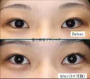 目頭切開：20代女性・理想の目元に 90日後 サムネイル用