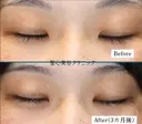 目頭切開：20代女性・理想の目元に 90日後 サムネイル用
