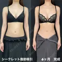 シークレット脂肪吸引 90日後 サムネイル用