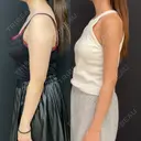 シークレット脂肪吸引 before画像 サムネイル用
