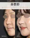 鼻中隔延長　肋軟骨 after画像 サムネイル用