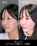糸リフト/ヒアルロン酸注入（貴族） before画像 サムネイル用