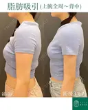 腕の脂肪もたつきを改善🌴コンプリート脂肪吸引【上腕全周～お背中一部】形成外科専門医がご対応 before画像 サムネイル用