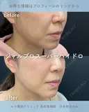 ジャルプロスーパーハイドロ after画像 サムネイル用