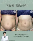 腹部脂肪吸引　『落ちない脂肪は、プロに任せるという選択を✨』 before画像 サムネイル用