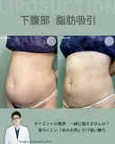 腹部脂肪吸引　『落ちない脂肪は、プロに任せるという選択を✨』 90日後 サムネイル用