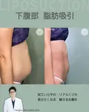 腹部脂肪吸引　『落ちない脂肪は、プロに任せるという選択を✨』 after画像 サムネイル用