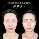 糸リフト 30日後 サムネイル用