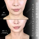 糸リフト before画像 サムネイル用