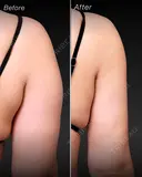 脇肉撃退で後ろ姿に自信✨｜二の腕と脇肉の360°脂肪吸引 after画像 サムネイル用