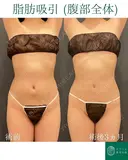 カリカリボディを目指す🌴コンプリート脂肪吸引【腹部フル】形成外科専門医がご対応 after画像 サムネイル用