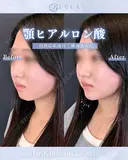 顎ヒアルロン酸 before画像 サムネイル用