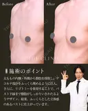 授乳後にしぼんだ胸…脂肪で叶うふっくらバスト✨ after画像 サムネイル用