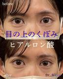 ヒアルロン酸 after画像 サムネイル用
