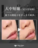 人中短縮（MIX型切開） 90日後 サムネイル用