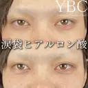 【👀涙袋ヒアルロン酸👀】 after画像 サムネイル用
