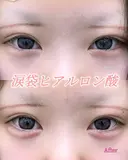 涙袋ヒアルロン酸 after画像 サムネイル用