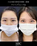 たるみ取り併用全切開二重術・アイバックリムーブ before画像 サムネイル用