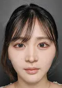 脂肪吸引（フェイスライン、ジョール、あご下、エラ下、メーラー）、糸リフト（転生リフト10本）、ヒアルロン酸注入（鼻翼基部、あご）、ボトックス（エラ） 30日後 サムネイル用