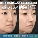 他院異物除去＋鼻フルコース［クローズ法］（肋軟骨・耳介軟骨使用）＋筋膜移植＋貴族手術（肋軟骨使用） 30日後 サムネイル用