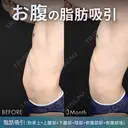脂肪吸引（腹部全体） before画像 サムネイル用