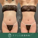 カリカリボディを目指す🌴コンプリート脂肪吸引【上下腹部・ウエスト・腰】形成外科専門医がご対応 before画像 サムネイル用
