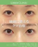 繊細に整えるクマ治療 before画像 サムネイル用