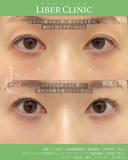 繊細に整えるクマ治療 after画像 サムネイル用