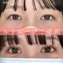 1Dayルラループ二重術 after画像 サムネイル用