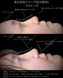 【鼻整形】鼻尖形成クローズ法＋耳介軟骨移植＋鼻背プロテーゼ after画像 サムネイル用