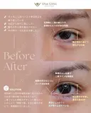 眼瞼下垂 / 目上切開 / 目頭切開 before画像 サムネイル用