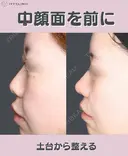 鼻尖形成　軟骨移植 before画像 サムネイル用