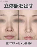 鼻プロテーゼ　小鼻縮小 before画像 サムネイル用