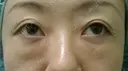 下まぶたの裏側からの脂肪除去(目の下の脂肪除去) | 30代 女性 before画像 サムネイル用