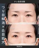 タレ目尻切開 after画像 サムネイル用