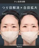 タレ目尻切開 after画像 サムネイル用