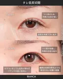 タレ目尻切開 after画像 サムネイル用